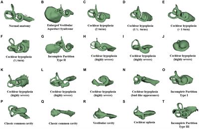 Cochlear implant electrode design for safe and effective treatment